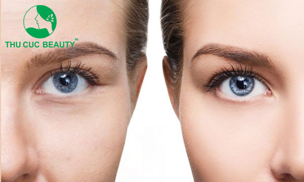Những hiểu lầm thường gặp về tiêm botox