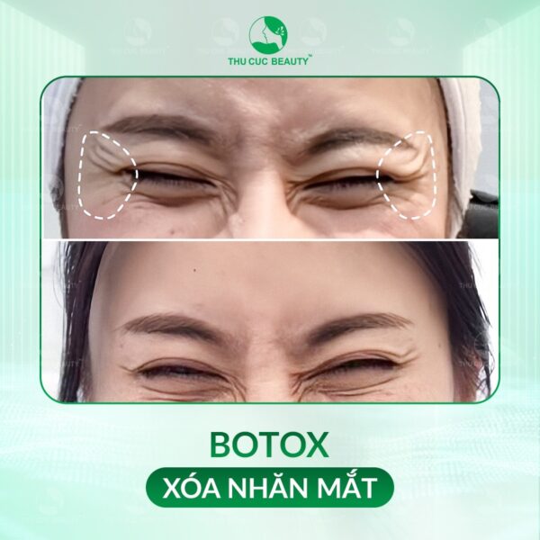 Tiêm botox hạn chế hình thành nếp nhăn hiệu quả.