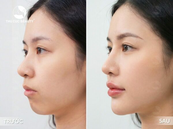 Tiêm filler cằm và những điều cần biết.