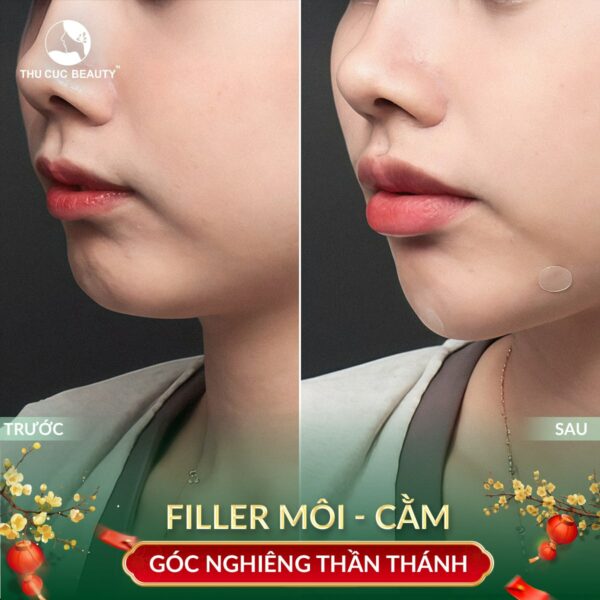 Tiêm filler cằm và những điều cần biết.