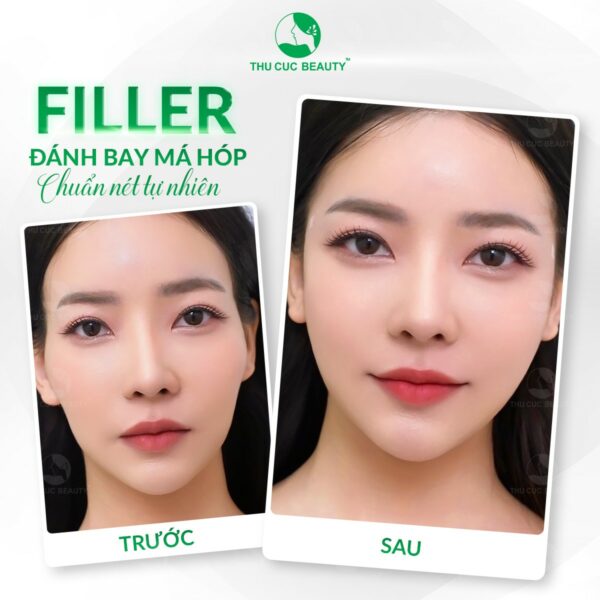 tiem filler ma hop e1772705829281