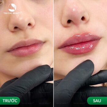 Tiêm filler môi kiêng ăn gì để môi nhanh vào form và bền?