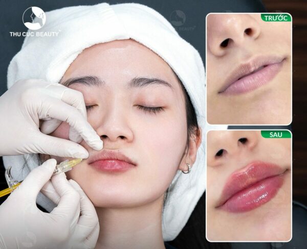 Tiêm filler môi có hại về sau không?