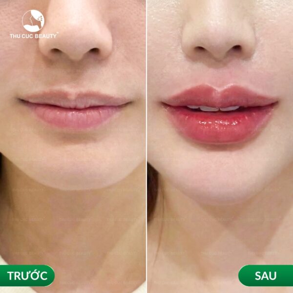 Tiêm filler môi bao lâu thì tan?