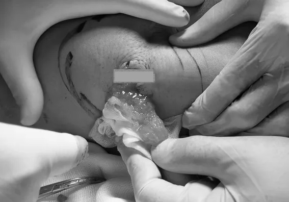 Biến chứng tiêm filler ngực