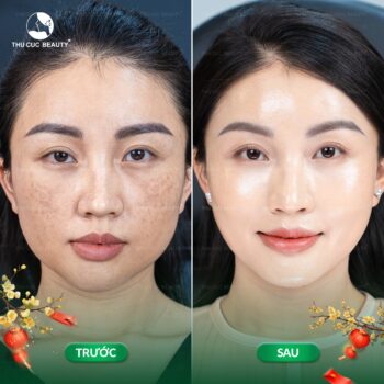 Có nên tiêm meso không? Những ai nên tiêm meso?