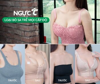 Treo ngực sa trễ không đặt túi có bị chảy xệ trở lại không?