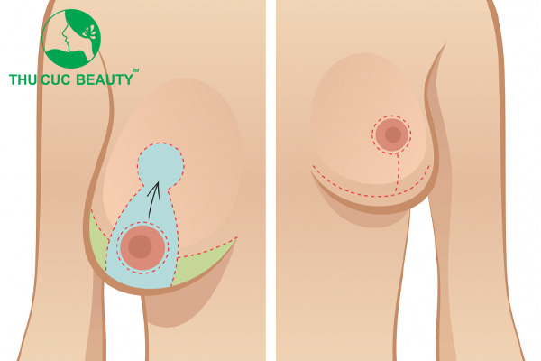 Treo ngực sa trễ không đặt túi có bị chảy xệ trở lại không?