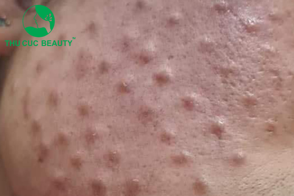 Biến chứng u hạt sau khi tiêm meso