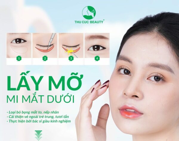 Phương pháp loại bỏ bọng mắt dưới to 