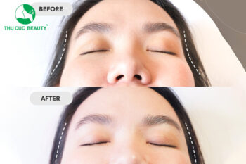 Cấy mỡ thái dương giữ được bao lâu?