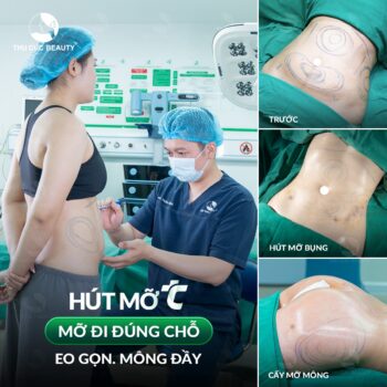 Hút mỡ bụng cấy mông có an toàn không?