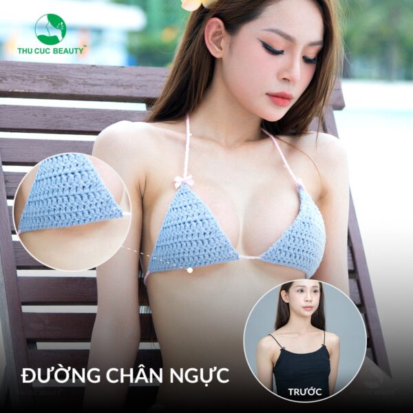 Nâng ngực không chạm giúp hạn chế để lại sẹo.