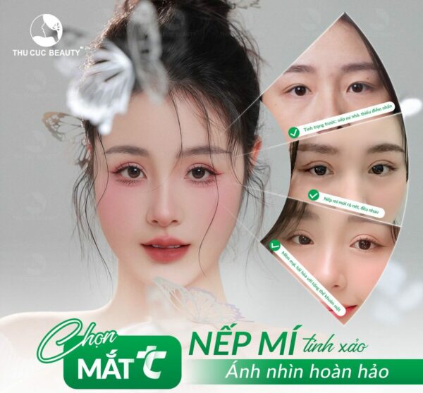 Cắt mí mắt bao lâu thì đẹp?