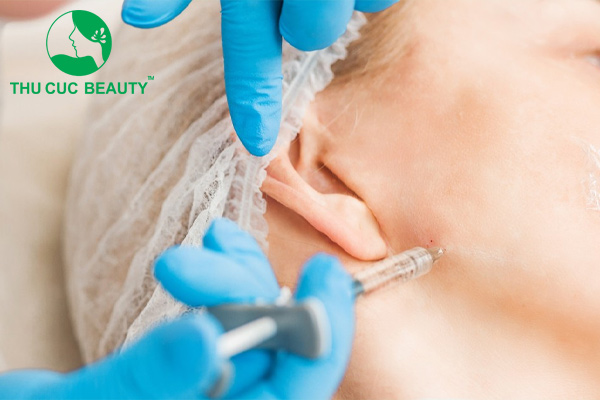 Tiêm Botox gọn hàm xuất hiện vết bầm tím nhỏ