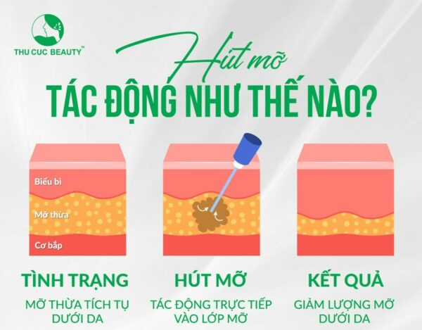 hut mo bap tay bang vaser lipo e1776250392547