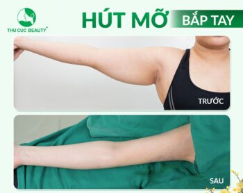 Hút mỡ bắp tay bằng công nghệ Vaser Lipo là gì?