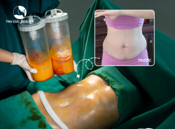 Hút mỡ bụng bao lâu hết sưng và vào form?