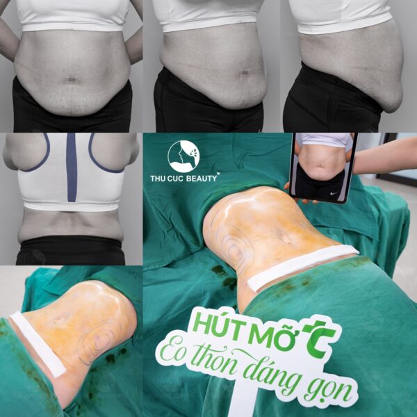 Hút mỡ tạo hình thành bụng đem lại vóc dáng nuột nà.