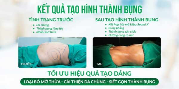 Hiệu quả hút mỡ tạo thành bụng