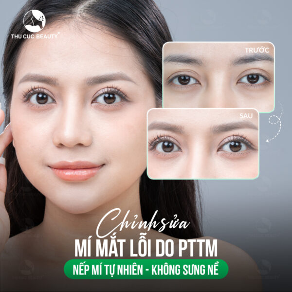 Kinh nghiệm cắt mí lần 2