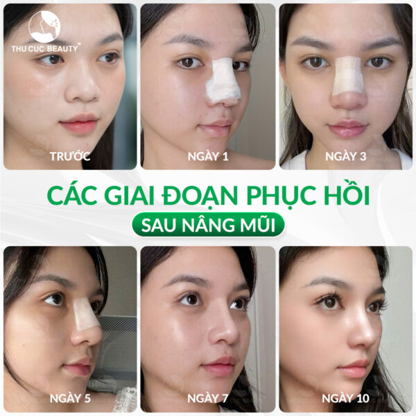 Tại sao không nên nâng mũi quá cao? 4 nang mui thu cuc dep e1776247222386