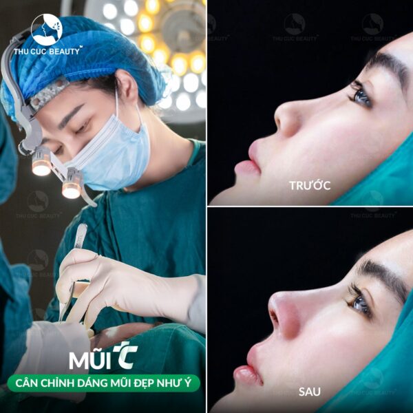 Nâng mũi đẹp, an toàn tại BVTM Thu Cúc