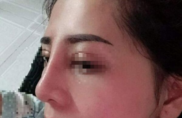 Nâng mũi quá cao khiến gương mặt mất cân đối 