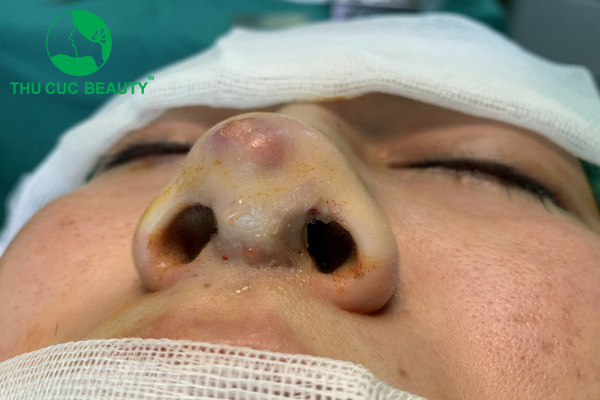 Nâng mũi quá cao dễ gây thủng mũi, lộ sụn.