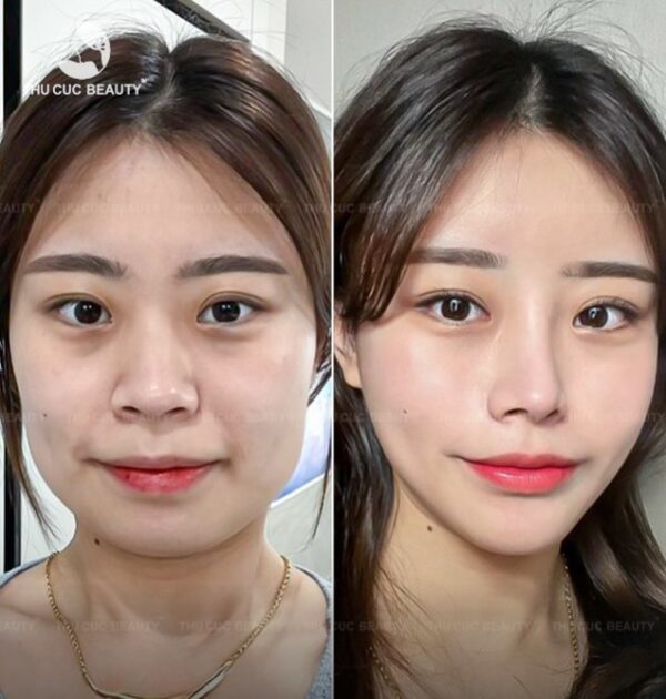 Các biểu hiện sau khi tiêm Botox gọn hàm thường gặp