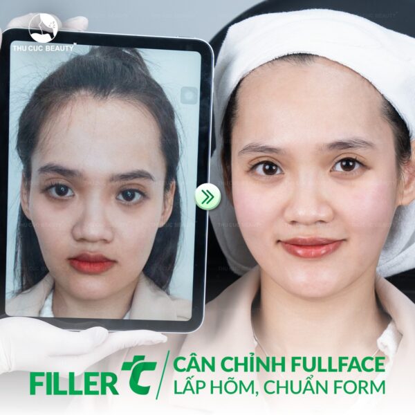 tiem botox va tiem filler e1776854184840