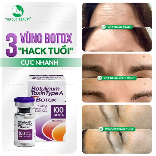 Tiêm xóa nhăn hiệu quả, an toàn tại Thu Cúc