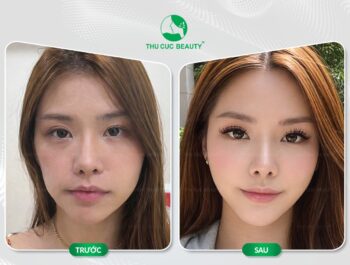 Tiêm filler rồi có cấy mỡ mặt được không?