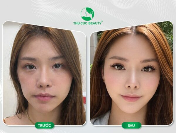Tiêm filler rồi có cấy mỡ được không?