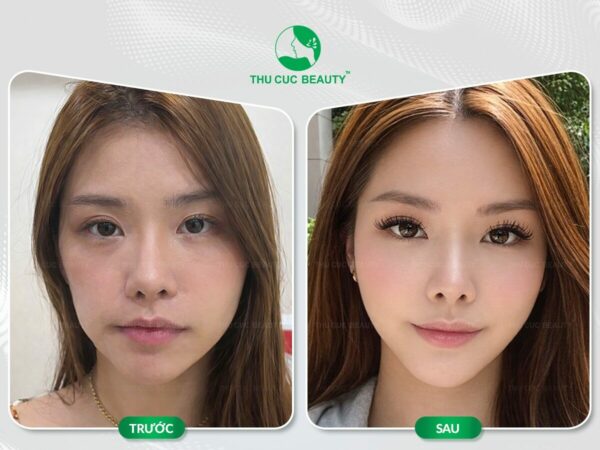 Tiêm filler da có bị chảy xệ không?