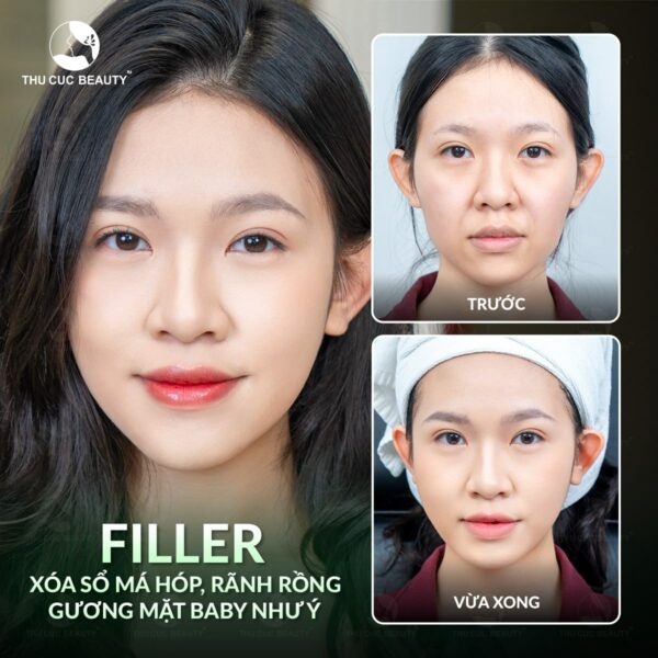 Tiêm filler là phương pháp làm đẹp an toàn, ít xâm lấn.