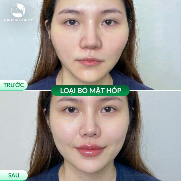 Tiêm filler da có bị chảy xệ không?