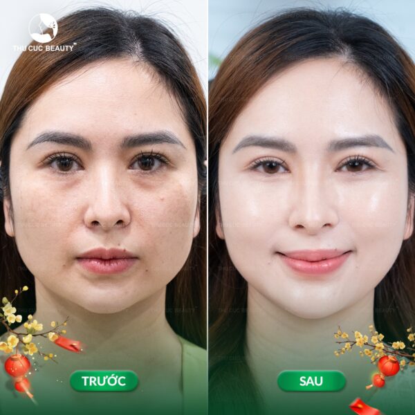 Tiêm meso không cần kiêng quá nhiều nhưng cũng cần thực hiện nghiêm túc để da đẹp tối ưu.