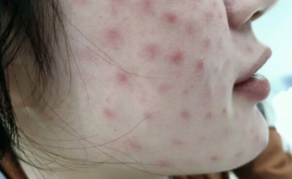 tiem meso nen kieng an gi e1777092777105