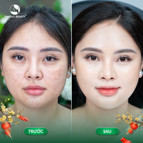 Quy trình hồi phục da sau khi tiêm meso