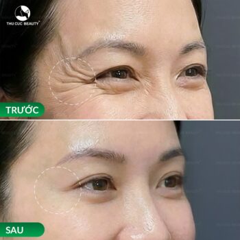 Tiêm xóa nhăn mắt giá bao nhiêu?