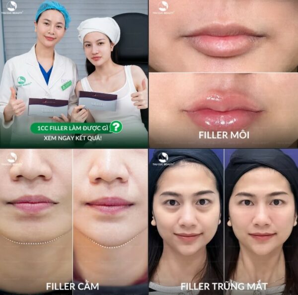 1CC filler có nhiều không? Tiêm 1CC filler hiệu quả như thế nào?