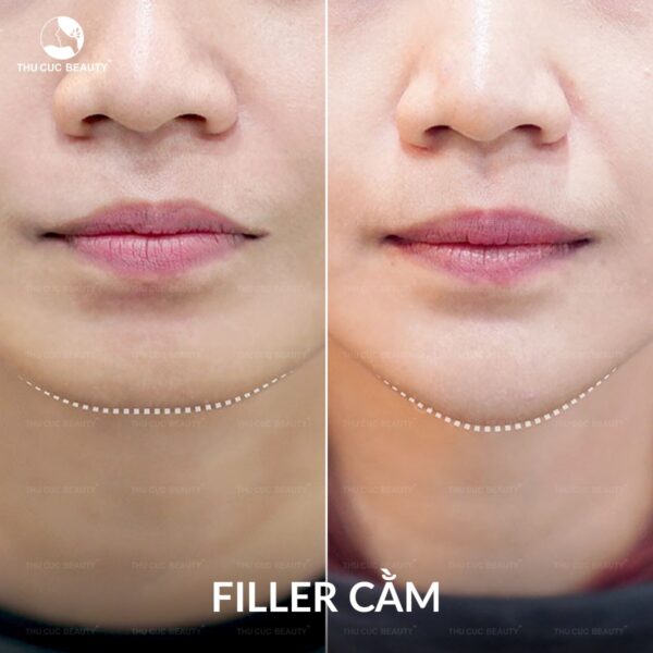 Cải thiện cằm ngắn với 1CC filler