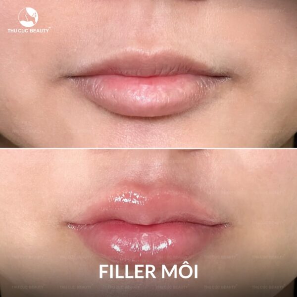1CC filler giúp môi căng mọng, đầy đặn hơn