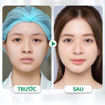 Cắt mí có làm mắt to hơn không?