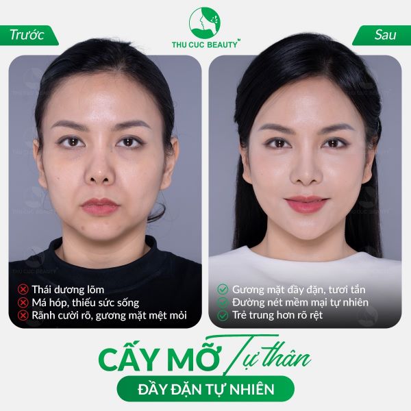 Cấy mỡ mặt giúp gương mặt trẻ trung, đầy đặn hơn.