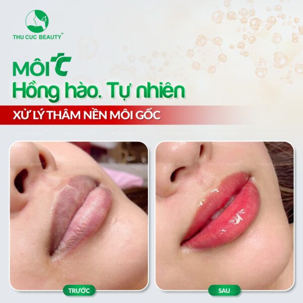 Trị môi thâm có được vĩnh viễn không?