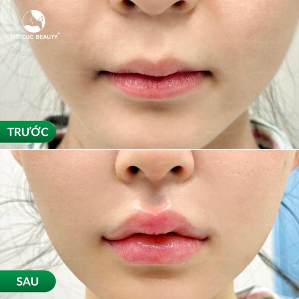 Tiêm khóe môi cười giúp gương mặt luôn tươi tắn, trẻ trung.