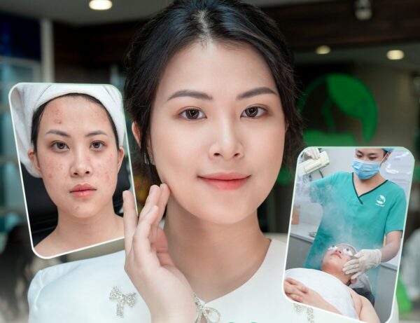 Quy trình điều trị mụn hiệu quả, an toàn tại Thu Cúc.