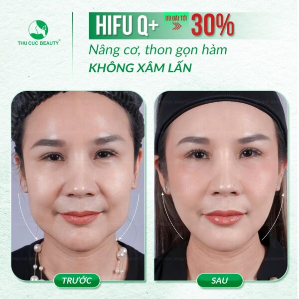 Giảm mỡ mặt, trẻ hóa bằng công nghệ HIFU
